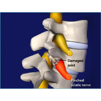Least Invasive Spine Surgery